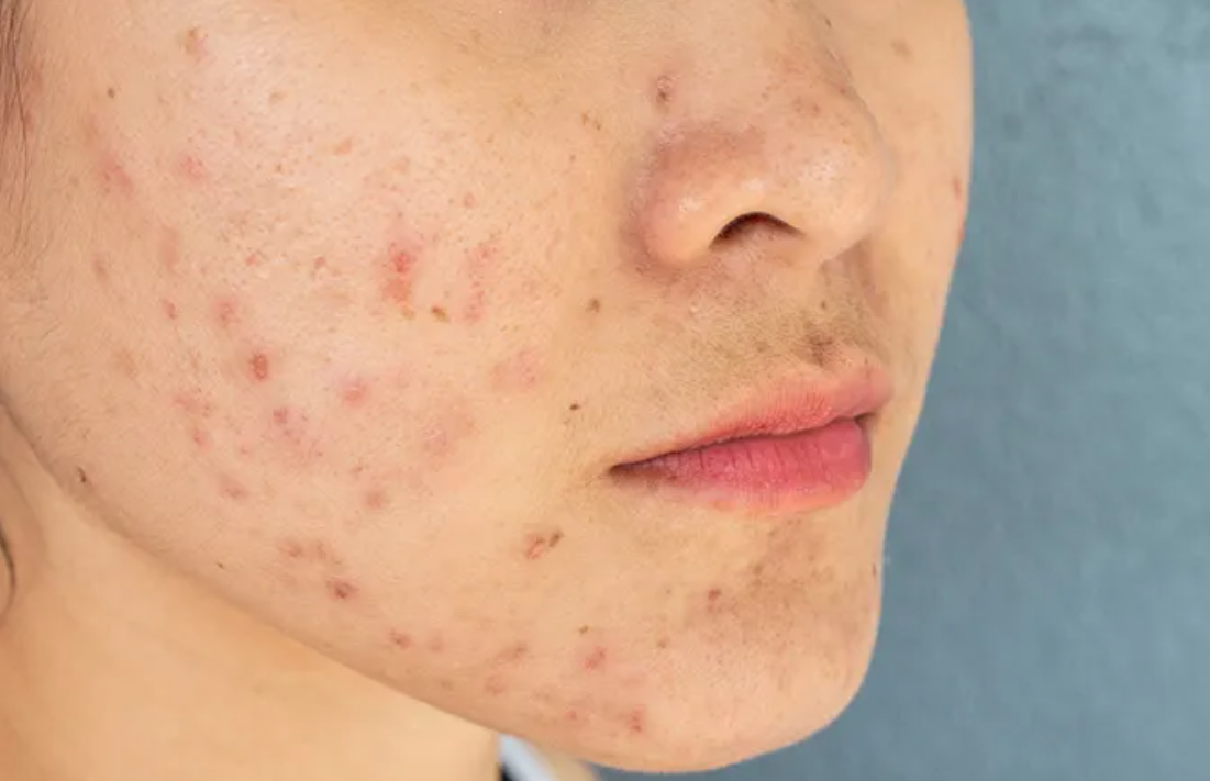 bahan alami untuk menghilangkan bekas jerawat