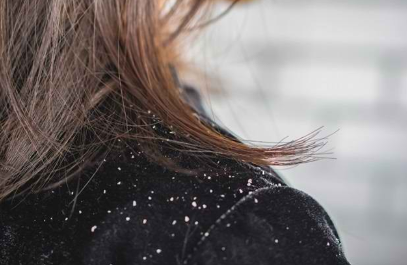 tips merawat kesehatan kulit kepala